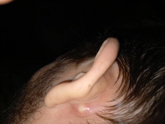 Boule Douloureuse Derriere L Oreille Kyste Sebacee Boule Douloureuse Derriere L Oreille Kyste Sebacee