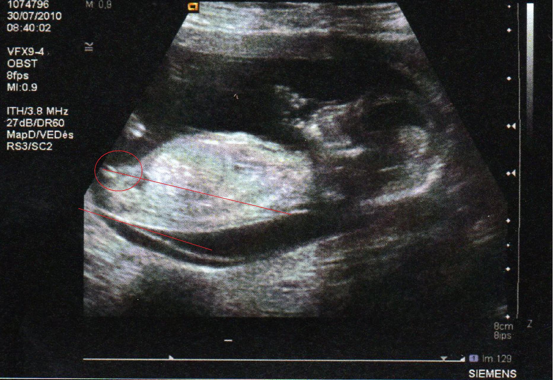 Bourgeon Genital Echo 13 Sa Echographie Connaitre Le Sexe De Votre Bebe Forum Grossesse Amp Bebe Doctissimo Bourgeon Genital Echo 13 Sa Echographie Connaitre Le Sexe De Votre Bebe Forum Grossesse Amp Bebe Doctissimo