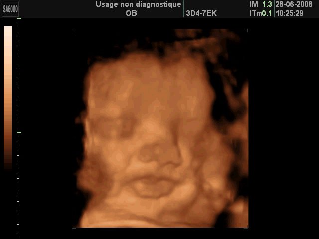 Photo Echo 3d 4d 5d Forum Libre Grossesse Et Bebe Forum Grossesse Amp Bebe Doctissimo Photo Echo 3d 4d 5d Forum Libre Grossesse Et Bebe Forum Grossesse Amp Bebe Doctissimo