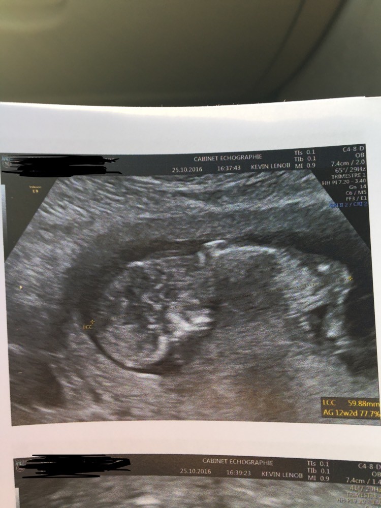 Echo 12 Sa Bebe Sur Le Dos Avis Aux Expertes Si Possibilite De Voir Qqch Echographie Connaitre Le Sexe De Votre Bebe Forum Grossesse Amp Bebe Doctissimo