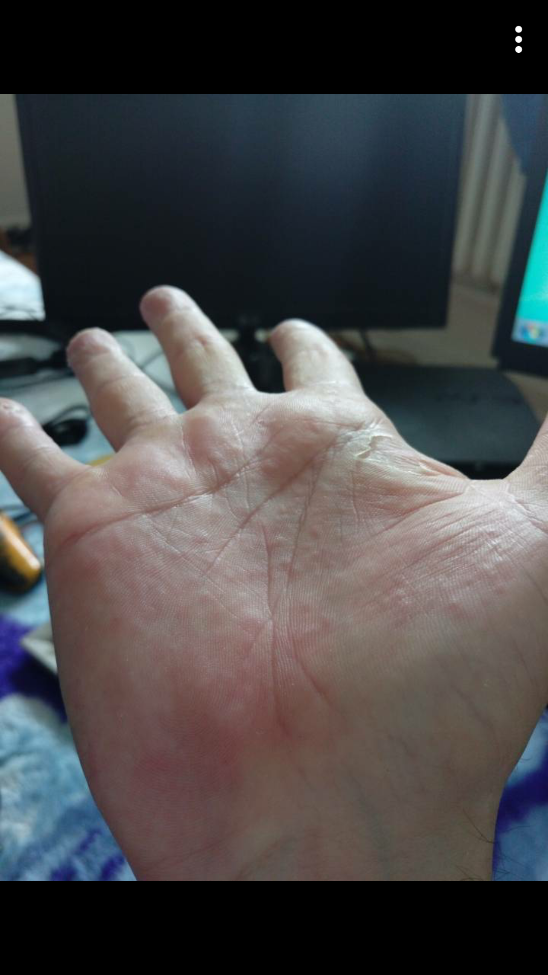 Petits Boutons Comme Des Gouttes D Eau Sur La Main Allergies Et Eczema Forum Sante Doctissimo