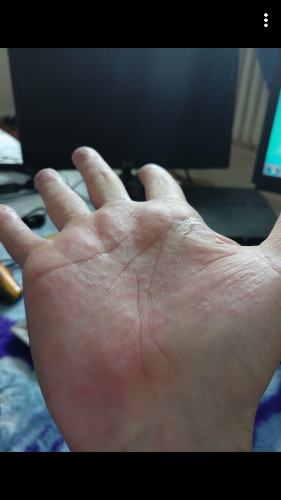 Petits boutons comme des gouttes d'eau sur la main. - Allergies et ...