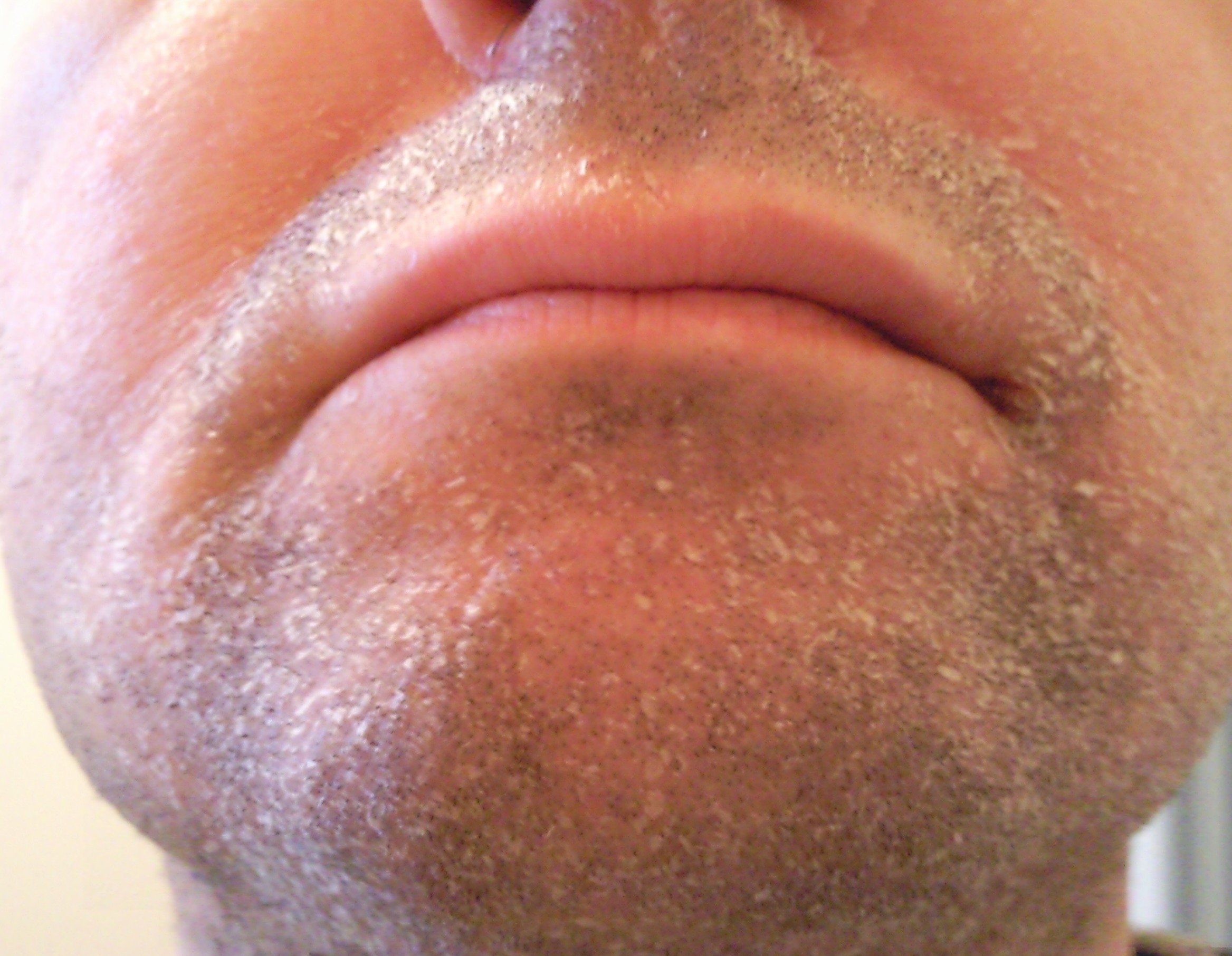 Visage Qui Pele Par Crise Acne Psoriasis Et Problemes De Peau Forum Sante Doctissimo Visage Qui Pele Par Crise Acne Psoriasis Et Problemes De Peau Forum Sante Doctissimo