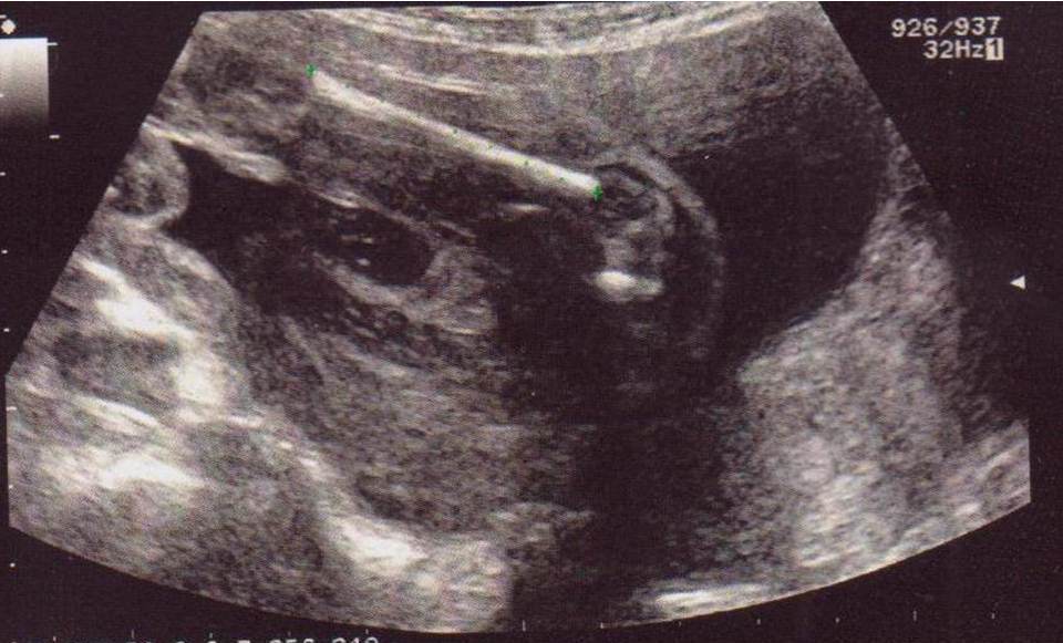 Echo 22sa Vague Photo Siege Garcon Fille Ou Non Identifiable Echographie Connaitre Le Sexe De Votre Bebe Forum Grossesse Amp Bebe Doctissimo Echo 22sa Vague Photo Siege Garcon Fille Ou Non Identifiable Echographie Connaitre Le Sexe De Votre Bebe Forum Grossesse Amp Bebe Doctissimo