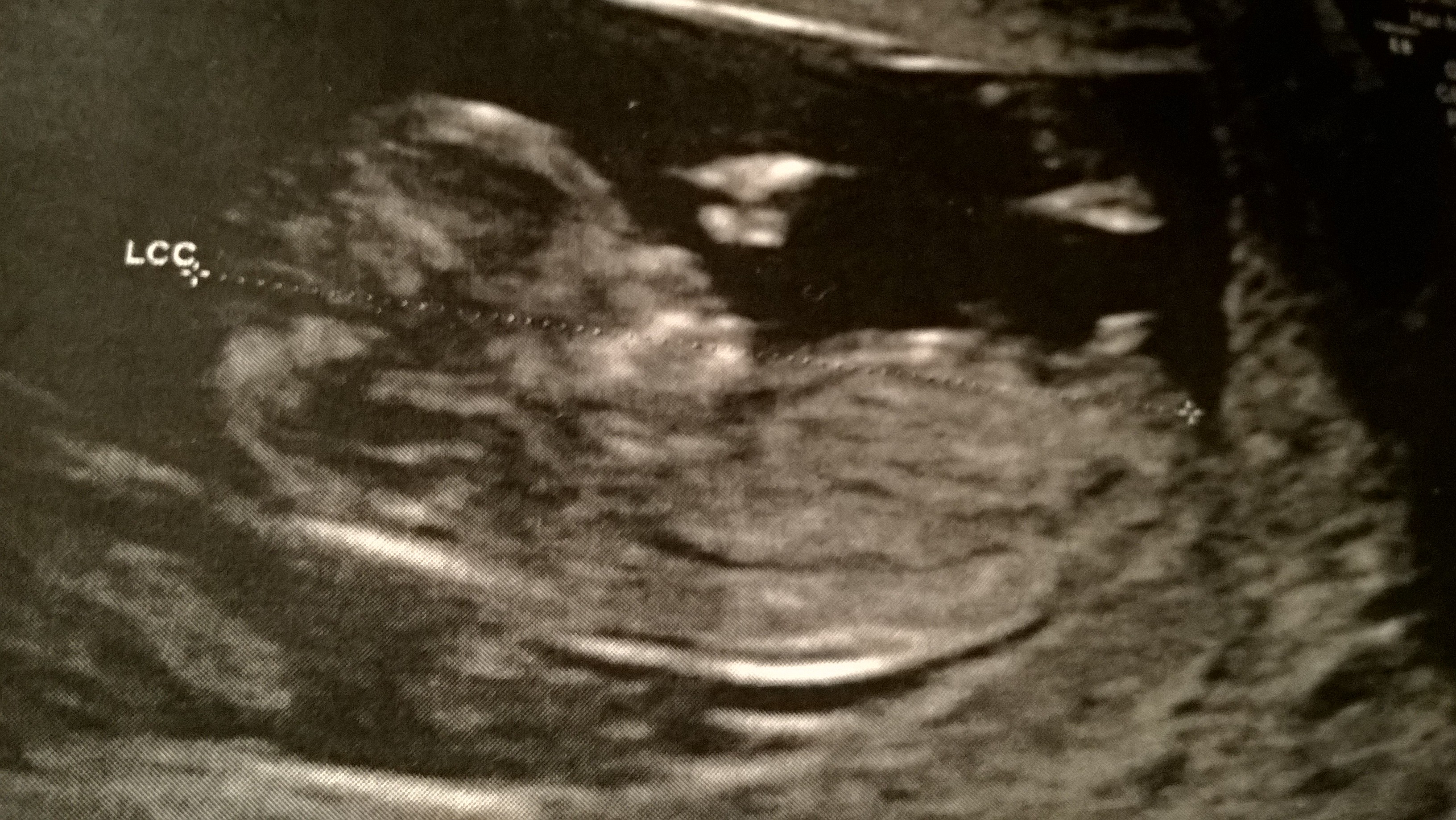 Echo 11sa 4 Echographie Connaitre Le Sexe De Votre Bebe Forum Grossesse Amp Bebe Doctissimo
