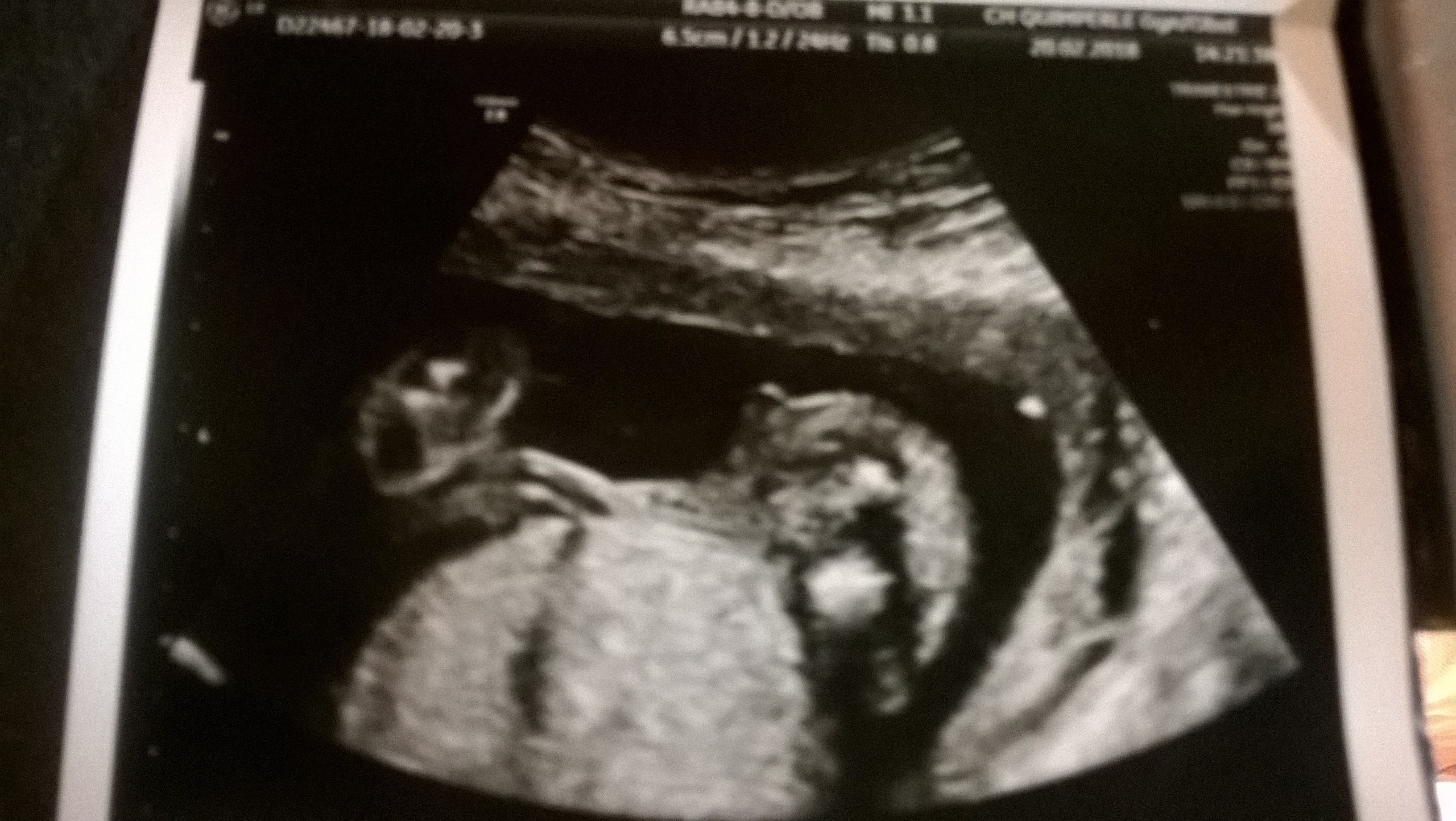 Echo 19sa Echographie Connaitre Le Sexe De Votre Bebe Forum Grossesse Amp Bebe Doctissimo Echo 19sa Echographie Connaitre Le Sexe De Votre Bebe Forum Grossesse Amp Bebe Doctissimo