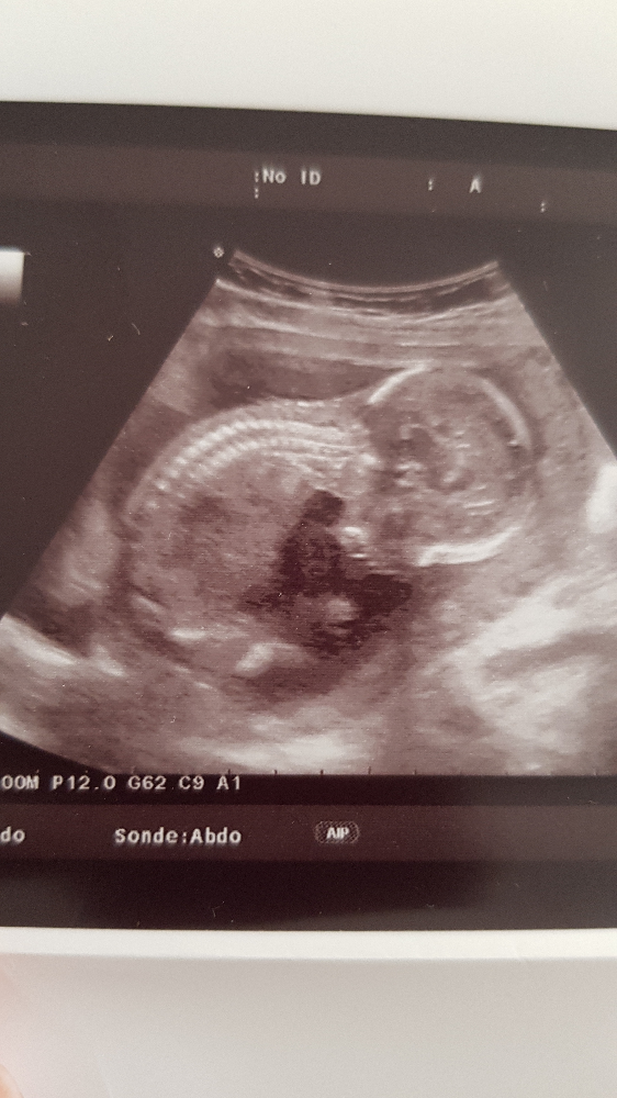 Pendule Garcon Fille Echographie Connaitre Le Sexe De Votre Bebe Forum Grossesse Amp Bebe Doctissimo