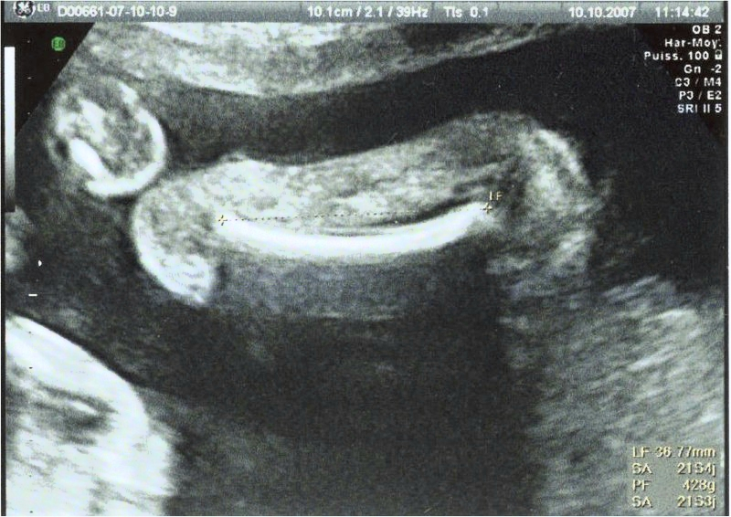 Echographie 26 Sa Sexe Bebe Echographie Connaitre Le Sexe De Votre Bebe Forum Grossesse Amp Bebe Doctissimo Echographie 26 Sa Sexe Bebe Echographie Connaitre Le Sexe De Votre Bebe Forum Grossesse Amp Bebe Doctissimo