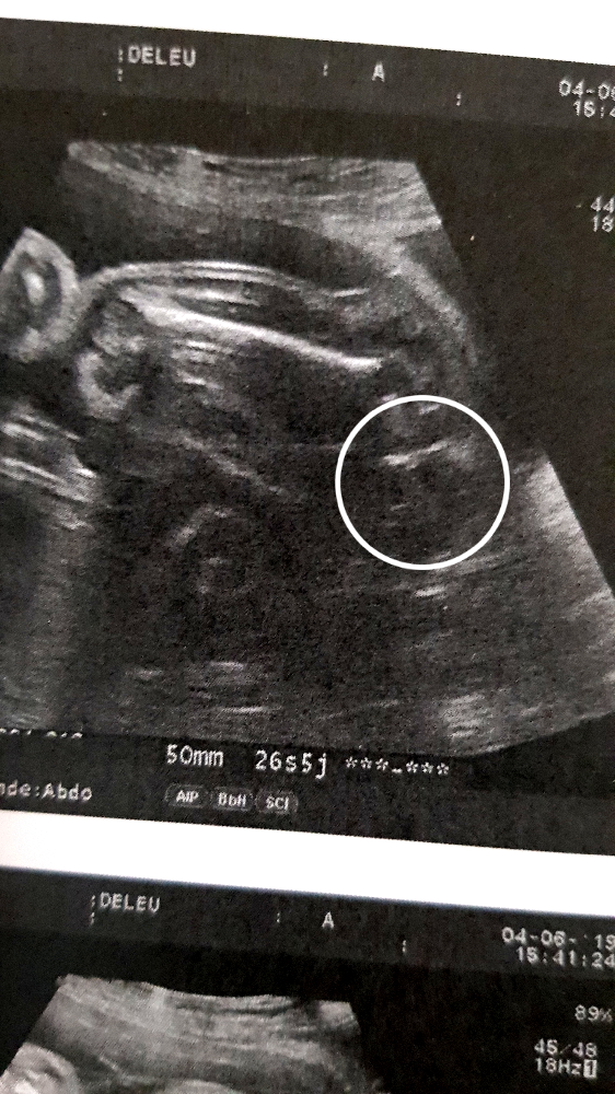 Echographie 26 Sa Sexe Bebe Echographie Connaitre Le Sexe De Votre Bebe Forum Grossesse Amp Bebe Doctissimo Echographie 26 Sa Sexe Bebe Echographie Connaitre Le Sexe De Votre Bebe Forum Grossesse Amp Bebe Doctissimo