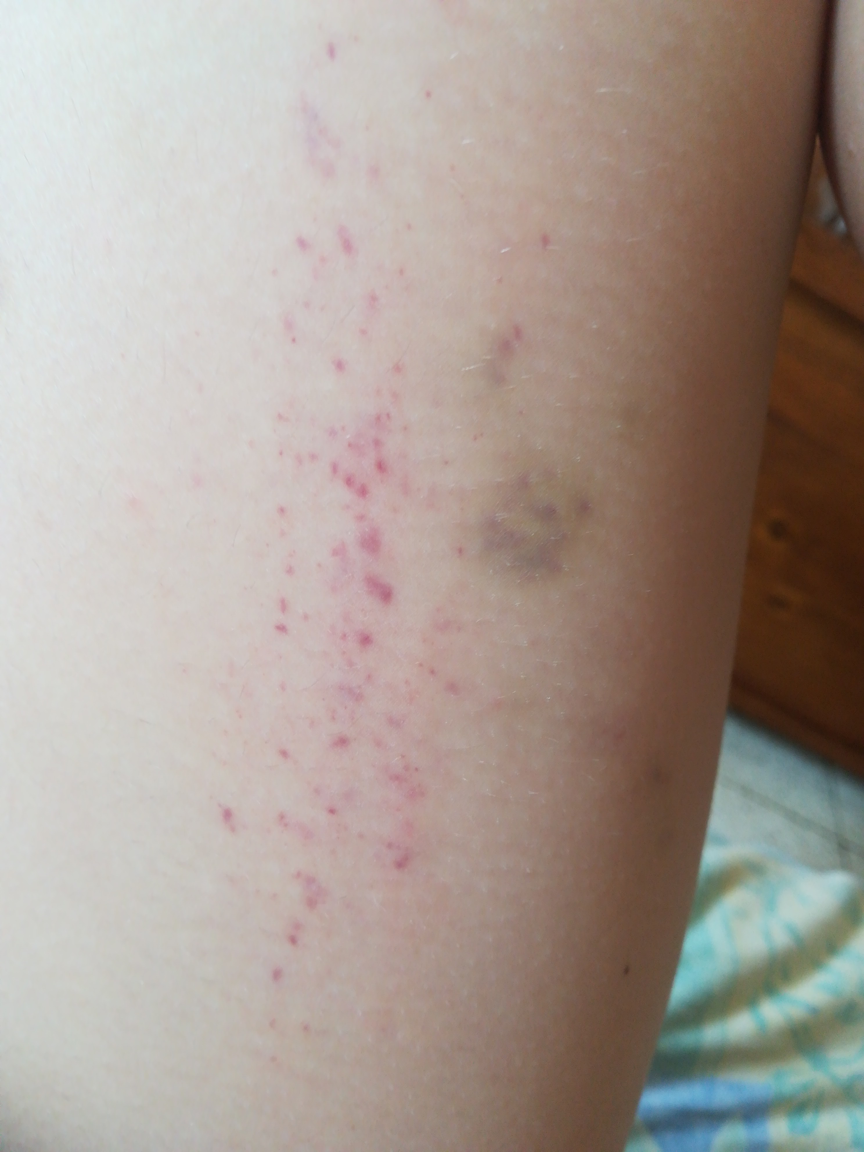 petite taches rouges violettes a l interieur de la cuisse acne psoriasis et problemes de peau forum sante doctissimo