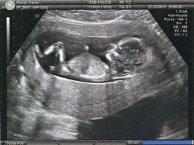 Voici Mon Echo A 13sa Ca Y Est Je Sais Le Sexe Echographie Connaitre Le Sexe De Votre Bebe Forum Grossesse Amp Bebe Doctissimo Voici Mon Echo A 13sa Ca Y Est Je Sais Le Sexe Echographie Connaitre Le Sexe De Votre Bebe Forum Grossesse Amp Bebe Doctissimo