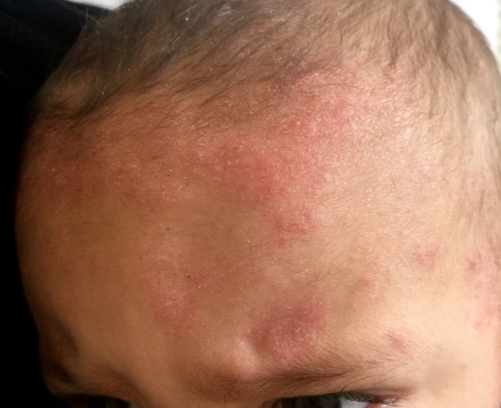 Encore Probleme De Peau Bebe Les Ramadanettes Forum Grossesse Amp Bebe Doctissimo Encore Probleme De Peau Bebe Les Ramadanettes Forum Grossesse Amp Bebe Doctissimo