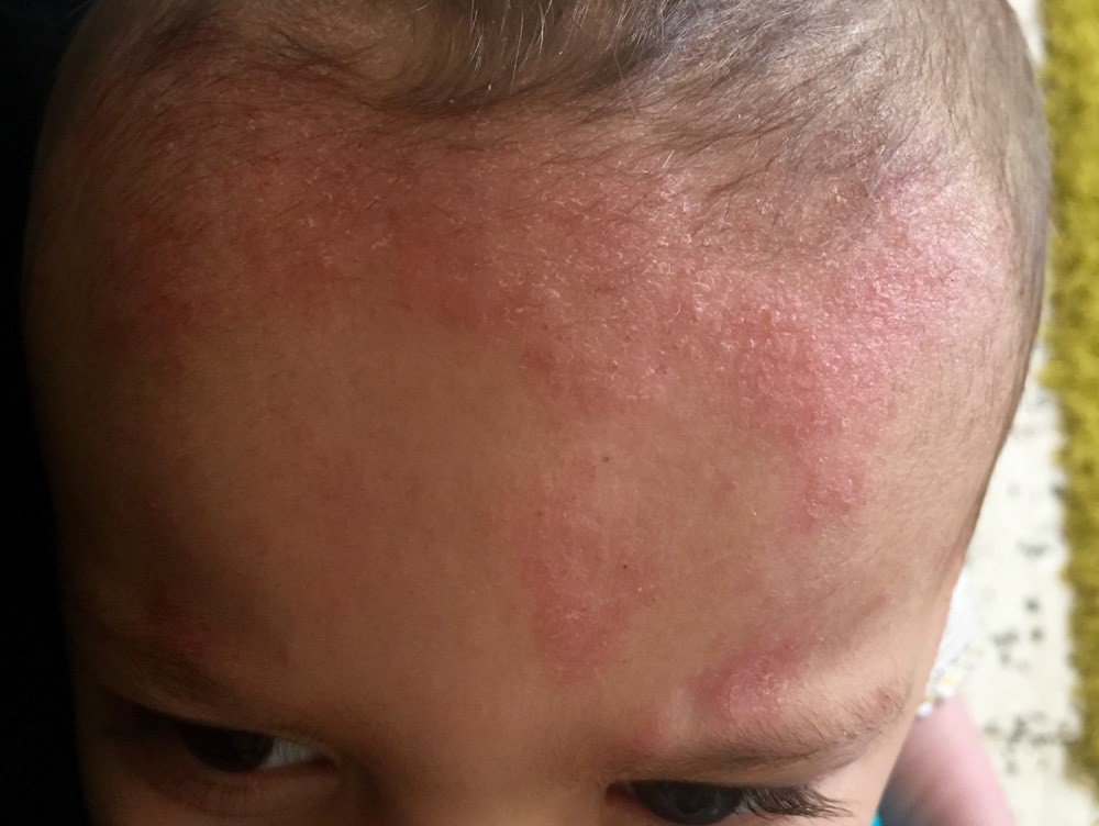 Encore Probleme De Peau Bebe Les Ramadanettes Forum Grossesse Amp Bebe Doctissimo Encore Probleme De Peau Bebe Les Ramadanettes Forum Grossesse Amp Bebe Doctissimo