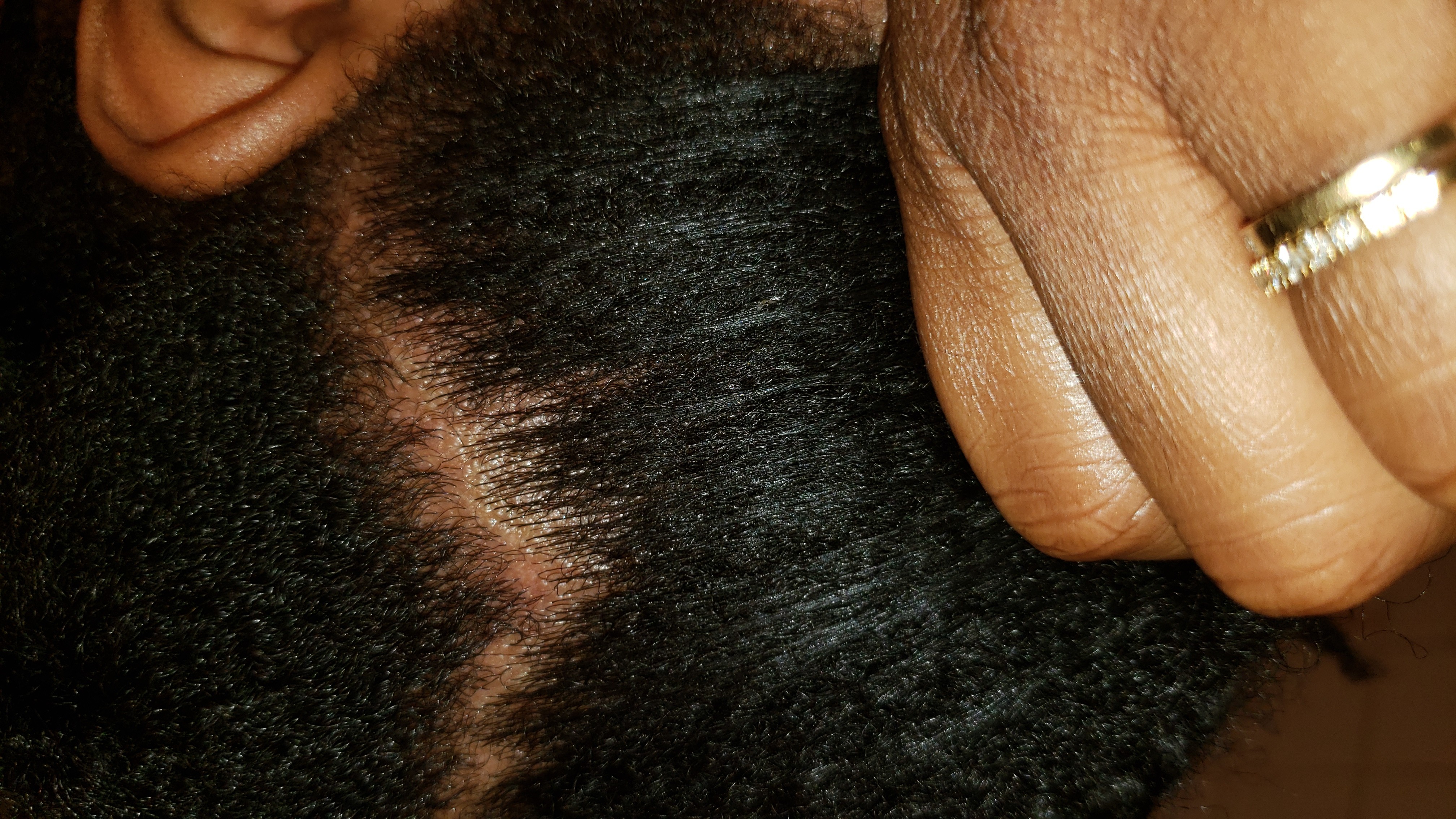 Boutons Cuir Chevelu Help Psoriasis Acne Psoriasis Et Problemes De Peau Forum Sante Doctissimo