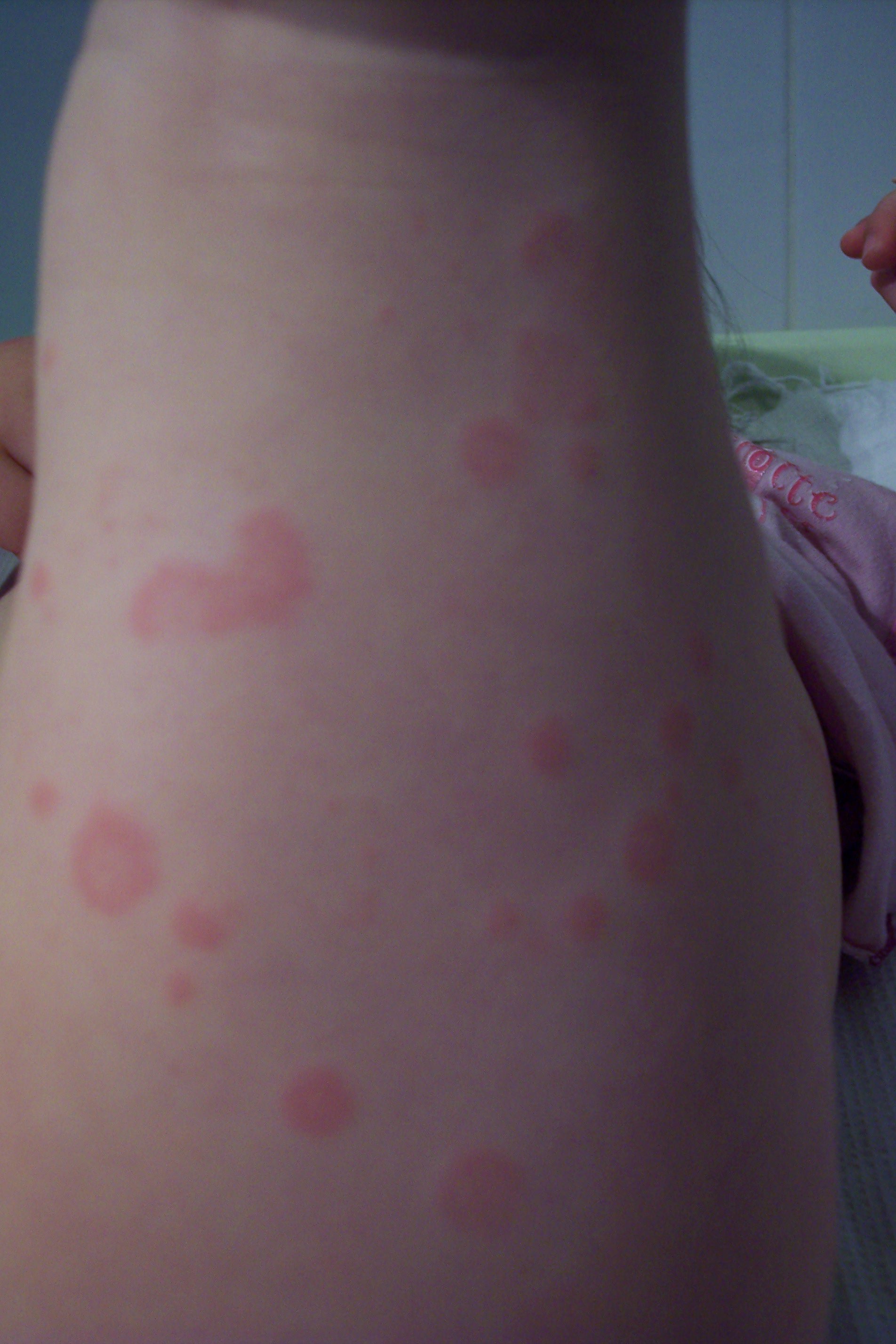 Plaque Rouge Avec Aureole Bebe 2ans Sante De L Enfant Forum Sante Doctissimo Plaque Rouge Avec Aureole Bebe 2ans Sante De L Enfant Forum Sante Doctissimo