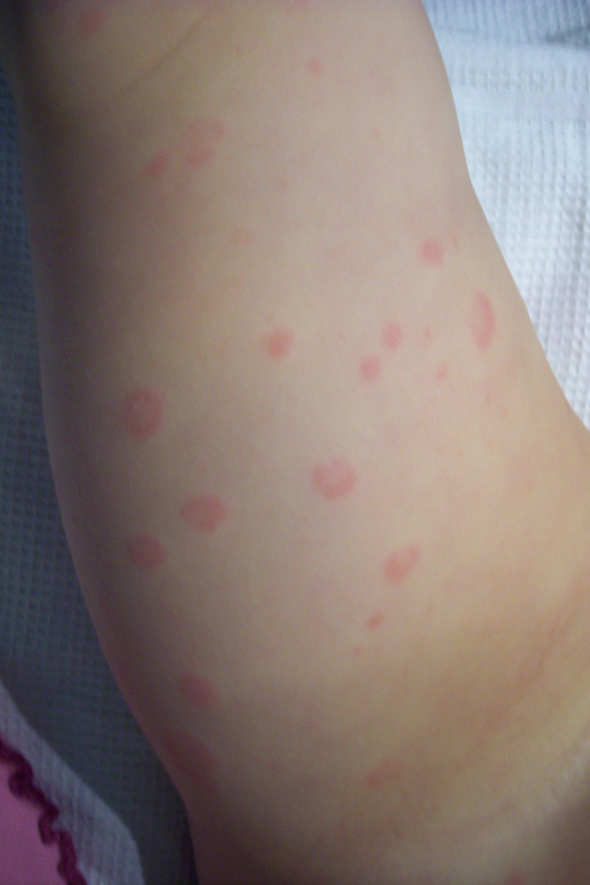 Plaque Rouge Avec Aureole Bebe 2ans Sante De L Enfant Forum Sante Doctissimo Plaque Rouge Avec Aureole Bebe 2ans Sante De L Enfant Forum Sante Doctissimo
