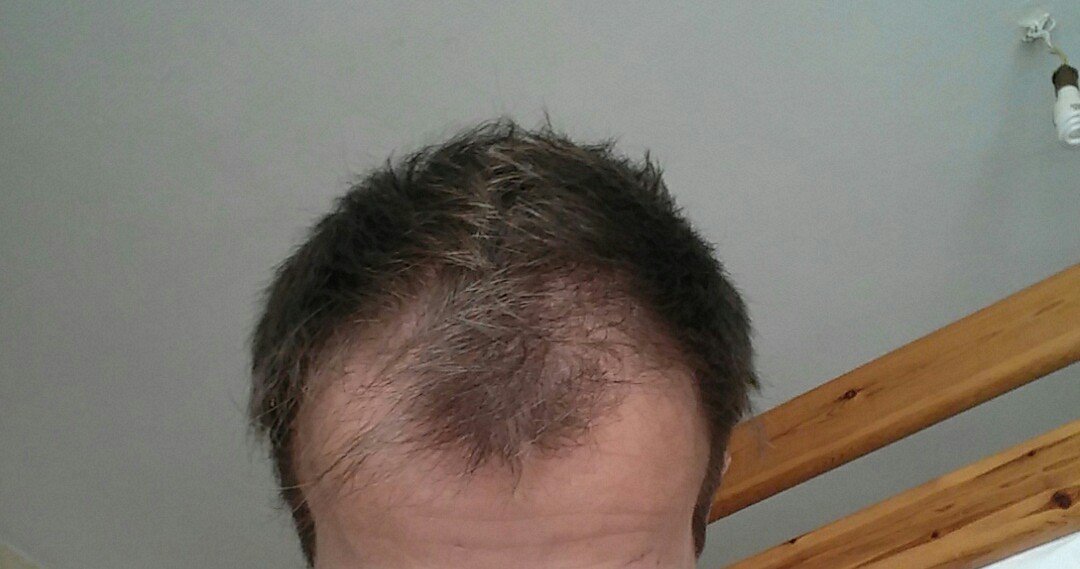 Mon Experience Avec Minoxidil 18 Mois Photo 12 12 16 Finasteride Calvitie Et Perte De Cheveux Forum Sante Doctissimo Mon Experience Avec Minoxidil 18 Mois Photo 12 12 16 Finasteride Calvitie Et Perte De Cheveux Forum Sante Doctissimo