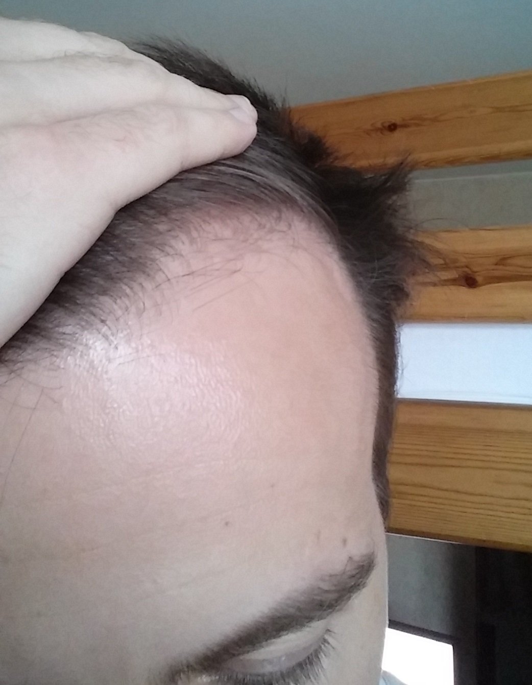 Mon Experience Avec Minoxidil 18 Mois Photo 12 12 16 Finasteride Calvitie Et Perte De Cheveux Forum Sante Doctissimo Mon Experience Avec Minoxidil 18 Mois Photo 12 12 16 Finasteride Calvitie Et Perte De Cheveux Forum Sante Doctissimo