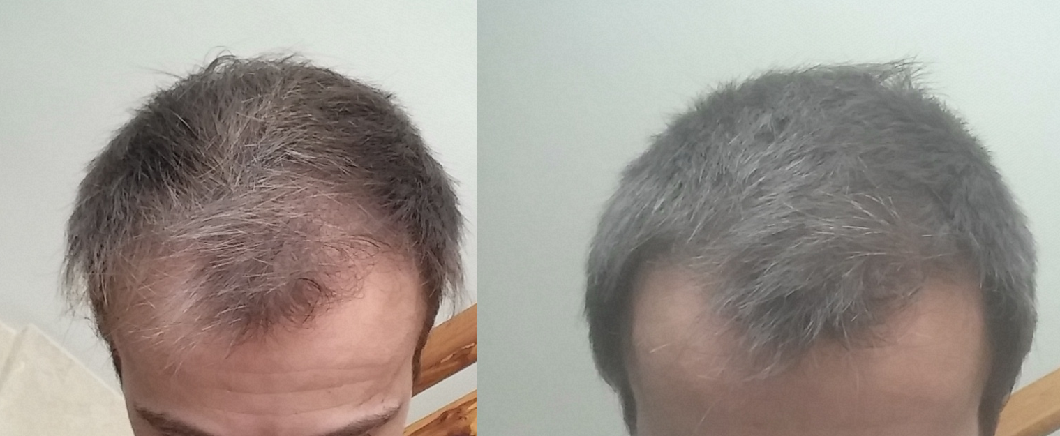 Mon expérience avec Minoxidil (18 mois photo), +12/12/2016 ...