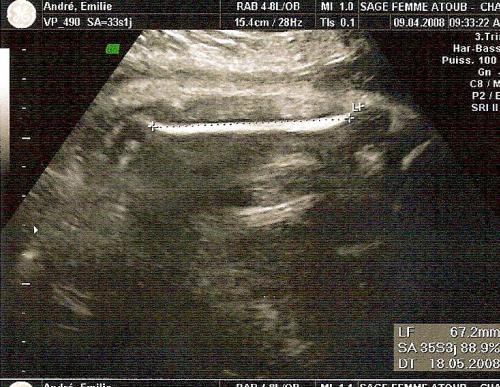 Echo 33 Sa 1 Estime 2 781 Kg Echographie Connaitre Le Sexe De Votre Bebe Forum Grossesse Amp Bebe Doctissimo Echo 33 Sa 1 Estime 2 781 Kg Echographie Connaitre Le Sexe De Votre Bebe Forum Grossesse Amp Bebe Doctissimo