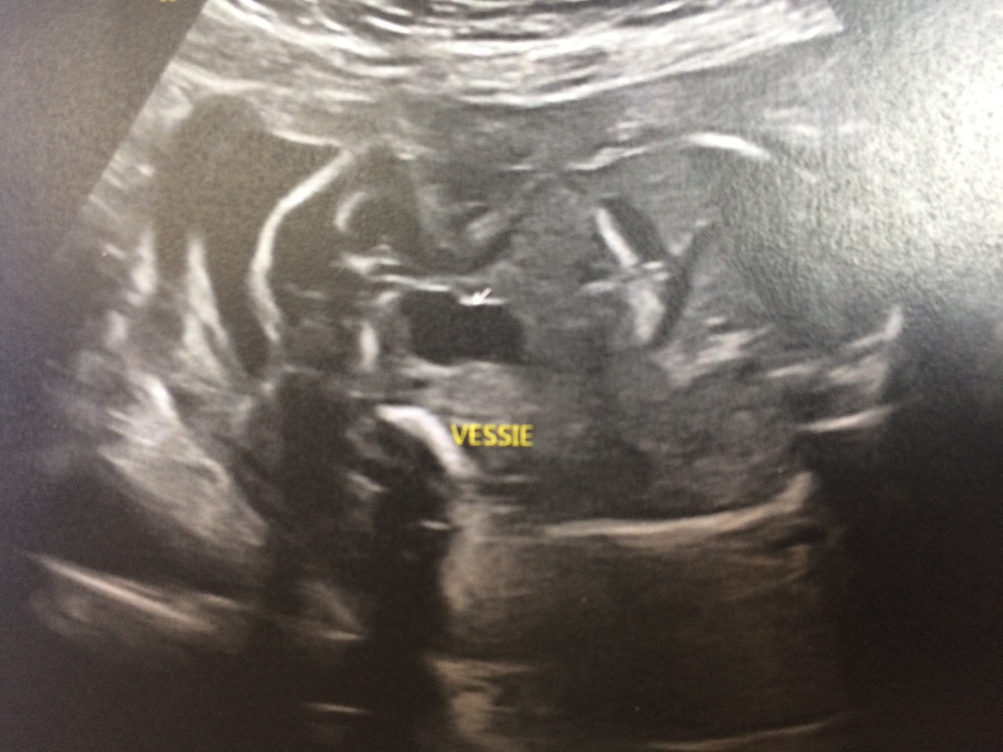 Echo Vessie Fille Ou Garcon Echographie Connaitre Le Sexe De Votre Bebe Forum Grossesse Amp Bebe Doctissimo Echo Vessie Fille Ou Garcon Echographie Connaitre Le Sexe De Votre Bebe Forum Grossesse Amp Bebe Doctissimo