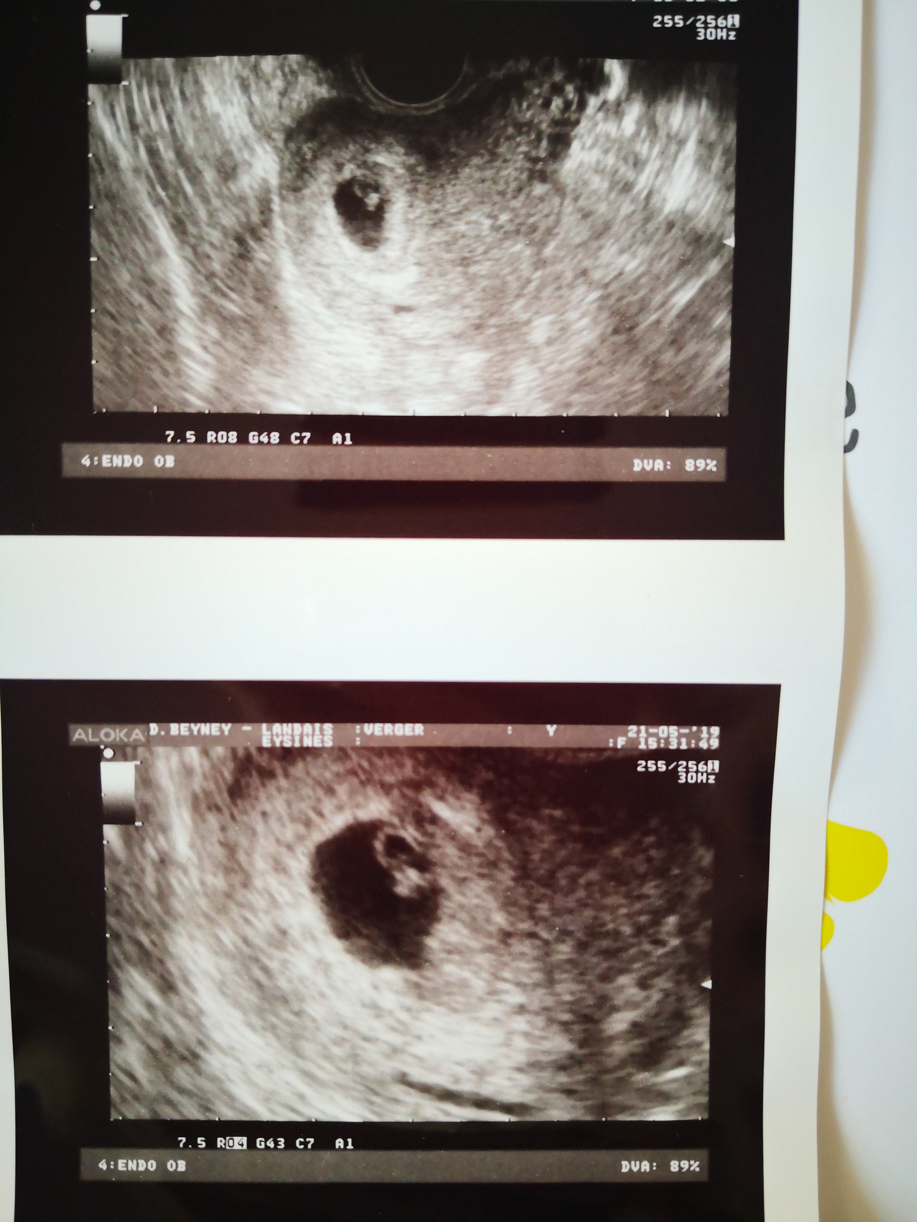 Fille Ou Garcon Selon Ramzi Echographie Connaitre Le Sexe De Votre Bebe Forum Grossesse Amp Bebe Doctissimo