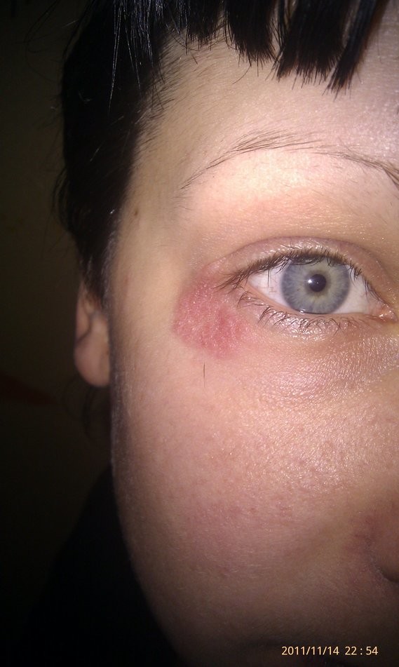 Tache Suspect Au Coin De L Oeil Tache Suspect Au Coin De L Oeil