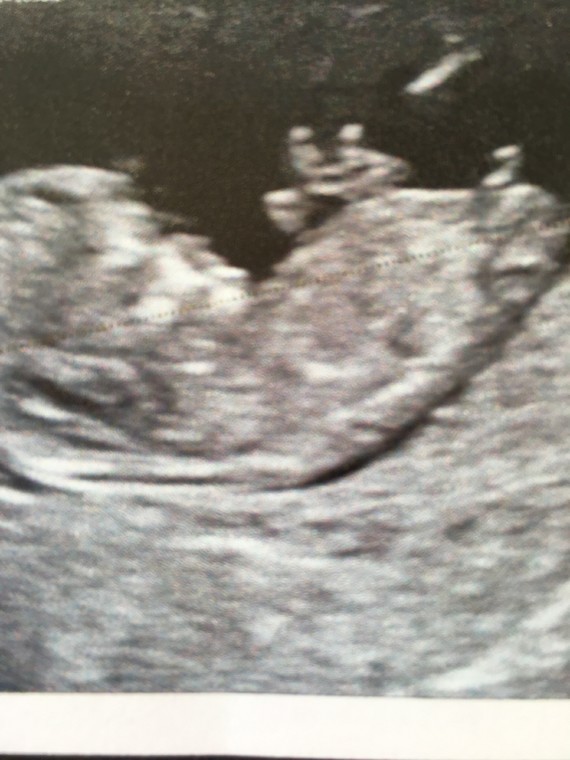 Pour Toutes Celles Qui Psychotent Sur Le Tubercule De Leur Bebe Pour Toutes Celles Qui Psychotent Sur Le Tubercule De Leur Bebe