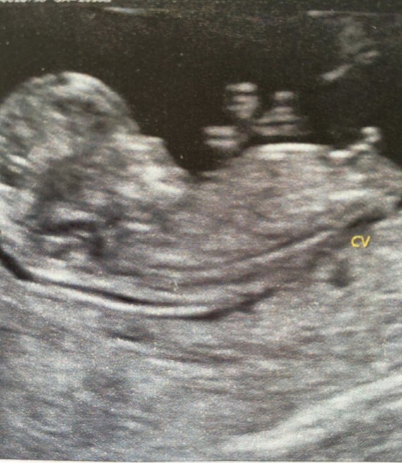 Pour Toutes Celles Qui Psychotent Sur Le Tubercule De Leur Bebe Pour Toutes Celles Qui Psychotent Sur Le Tubercule De Leur Bebe