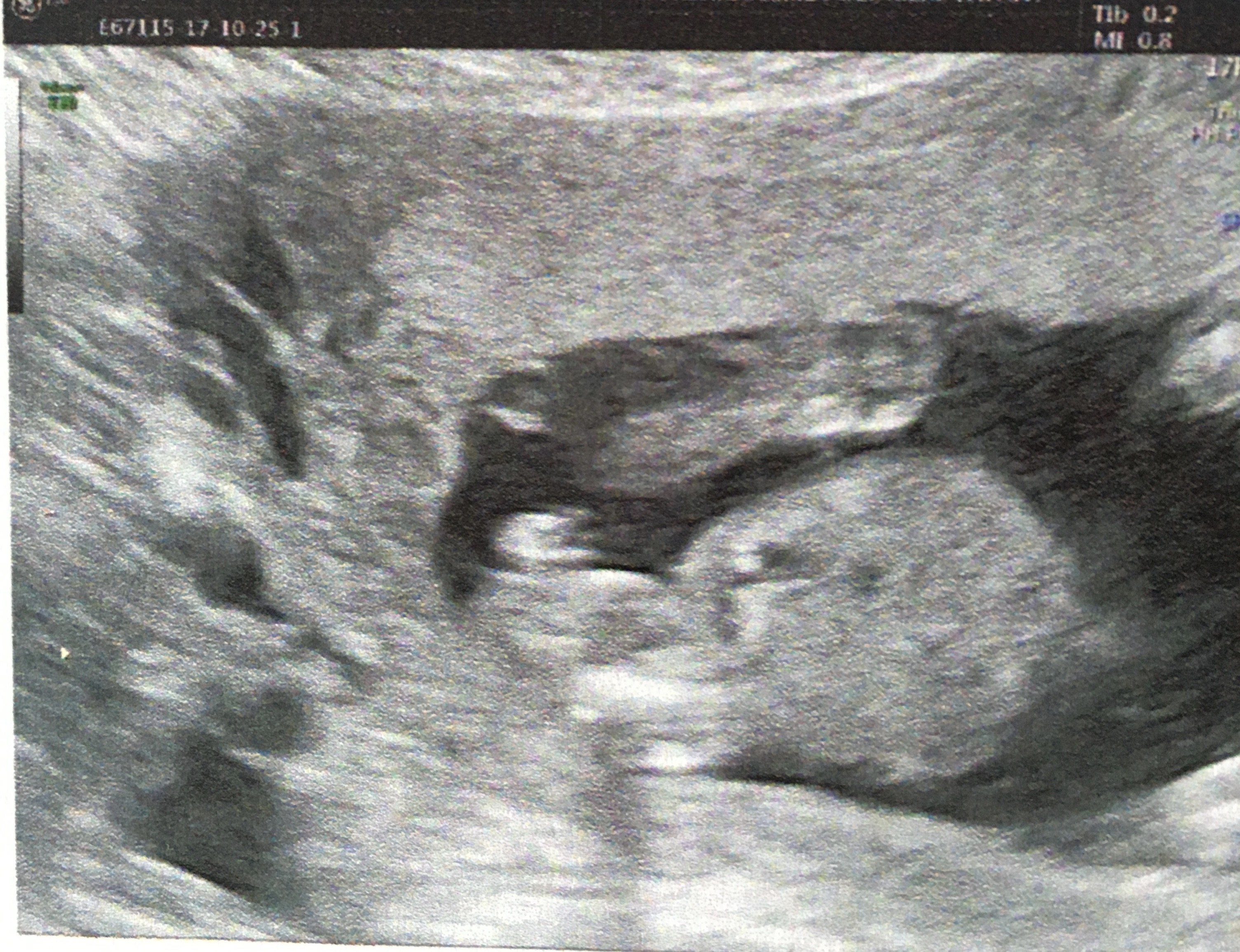 Pour Toutes Celles Qui Psychotent Sur Le Tubercule De Leur Bebe Echographie Connaitre Le Sexe De Votre Bebe Forum Grossesse Amp Bebe Doctissimo Pour Toutes Celles Qui Psychotent Sur Le Tubercule De Leur Bebe Echographie Connaitre Le Sexe De Votre Bebe Forum Grossesse Amp Bebe Doctissimo