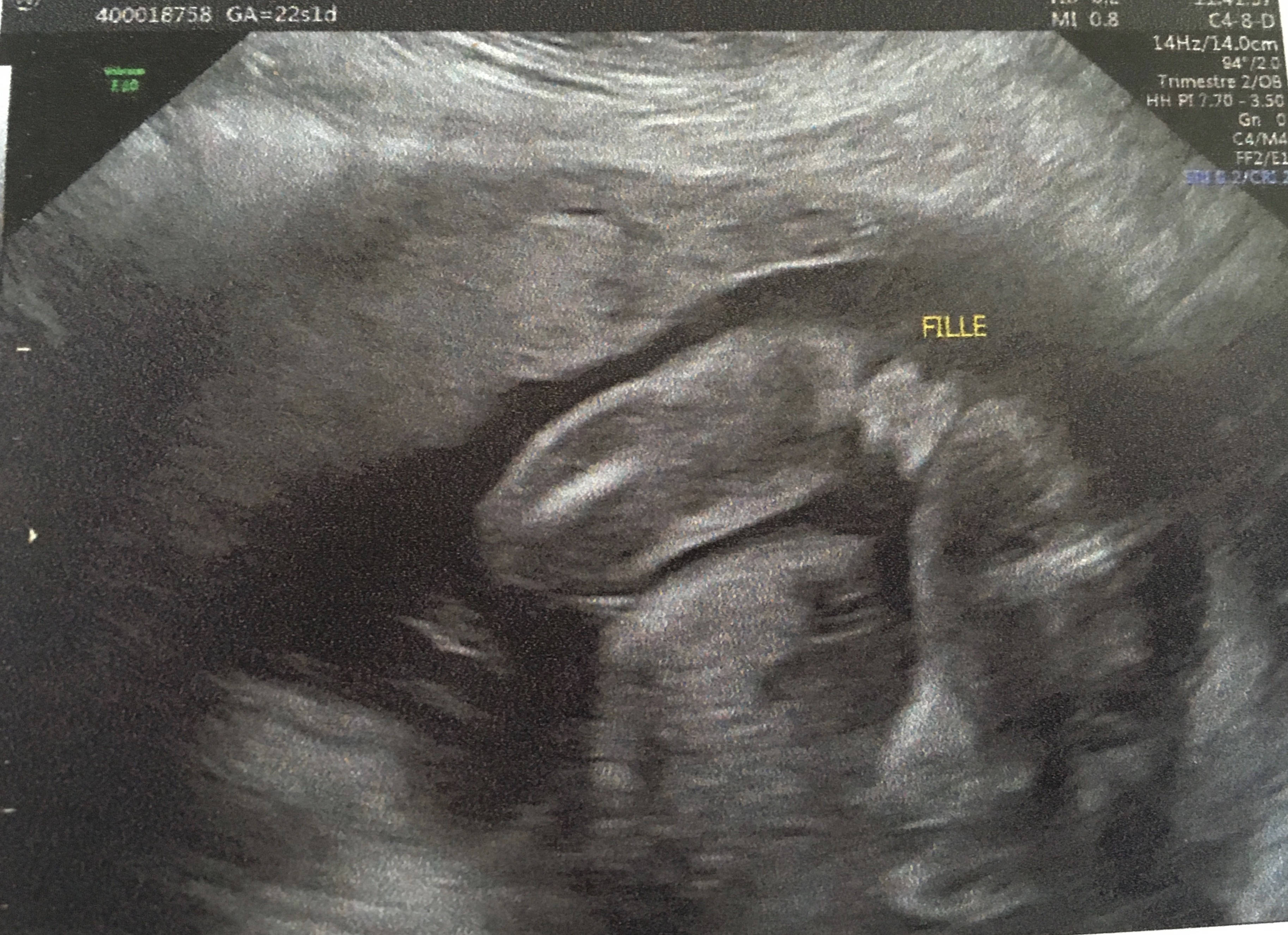 Pour Toutes Celles Qui Psychotent Sur Le Tubercule De Leur Bebe Echographie Connaitre Le Sexe De Votre Bebe Forum Grossesse Amp Bebe Doctissimo Pour Toutes Celles Qui Psychotent Sur Le Tubercule De Leur Bebe Echographie Connaitre Le Sexe De Votre Bebe Forum Grossesse Amp Bebe Doctissimo