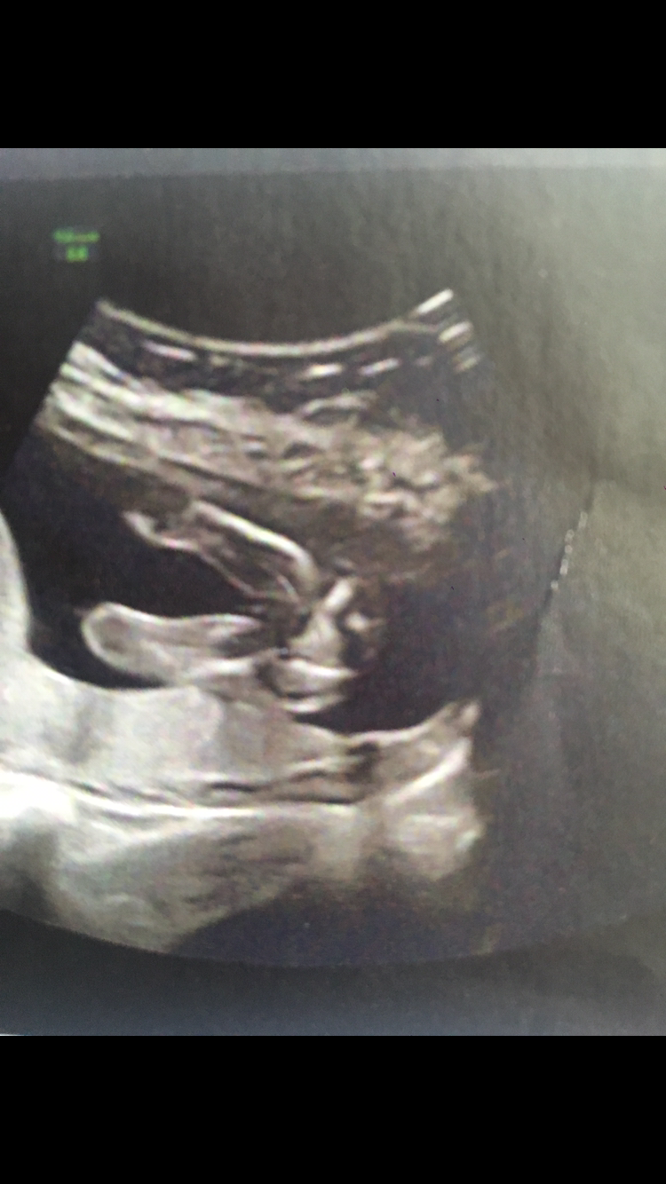 Garcon A 3 Mois Fille A 4 Mois Help Please Echographie Connaitre Le Sexe De Votre Bebe Forum Grossesse Amp Bebe Doctissimo Garcon A 3 Mois Fille A 4 Mois Help Please Echographie Connaitre Le Sexe De Votre Bebe Forum Grossesse Amp Bebe Doctissimo