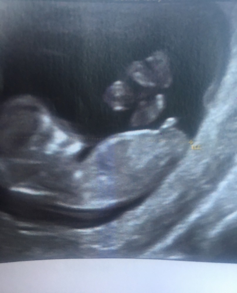 Garcon A 3 Mois Fille A 4 Mois Help Please Echographie Connaitre Le Sexe De Votre Bebe Forum Grossesse Amp Bebe Doctissimo Garcon A 3 Mois Fille A 4 Mois Help Please Echographie Connaitre Le Sexe De Votre Bebe Forum Grossesse Amp Bebe Doctissimo