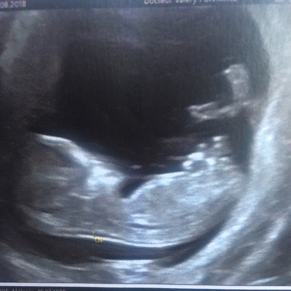 Garcon A 3 Mois Fille A 4 Mois Help Please Echographie Connaitre Le Sexe De Votre Bebe Forum Grossesse Amp Bebe Doctissimo Garcon A 3 Mois Fille A 4 Mois Help Please Echographie Connaitre Le Sexe De Votre Bebe Forum Grossesse Amp Bebe Doctissimo