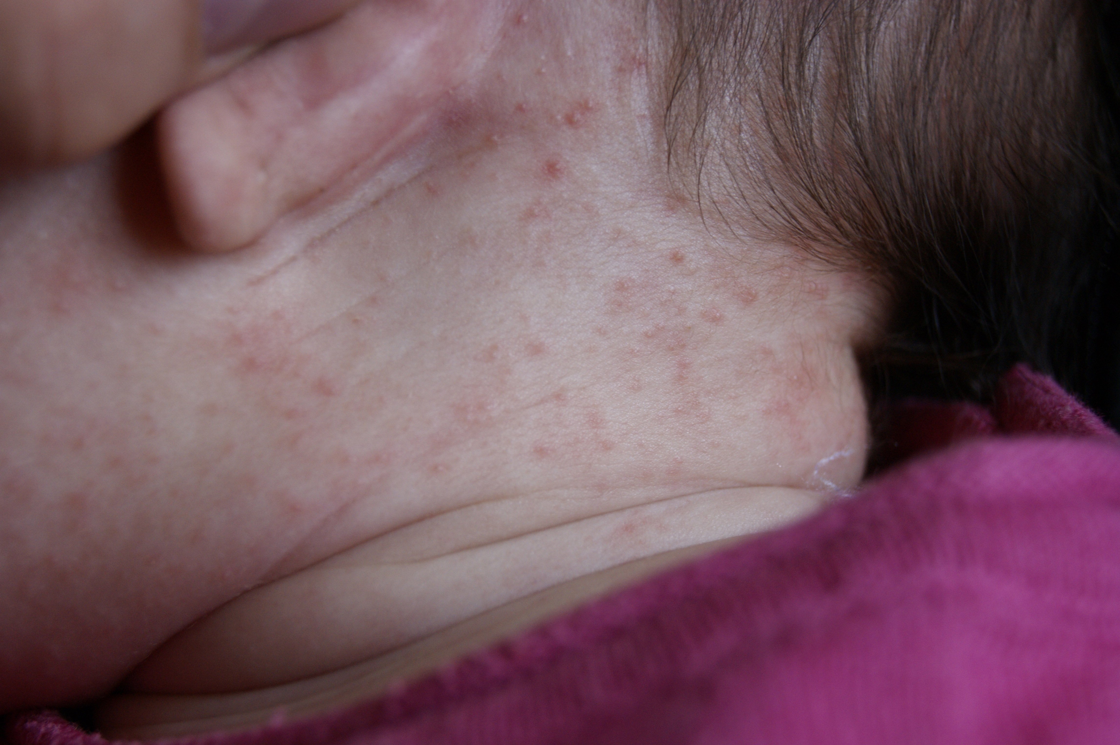 Plaques Rouges Sur Bebe Allergies Et Eczema Forum Sante Doctissimo