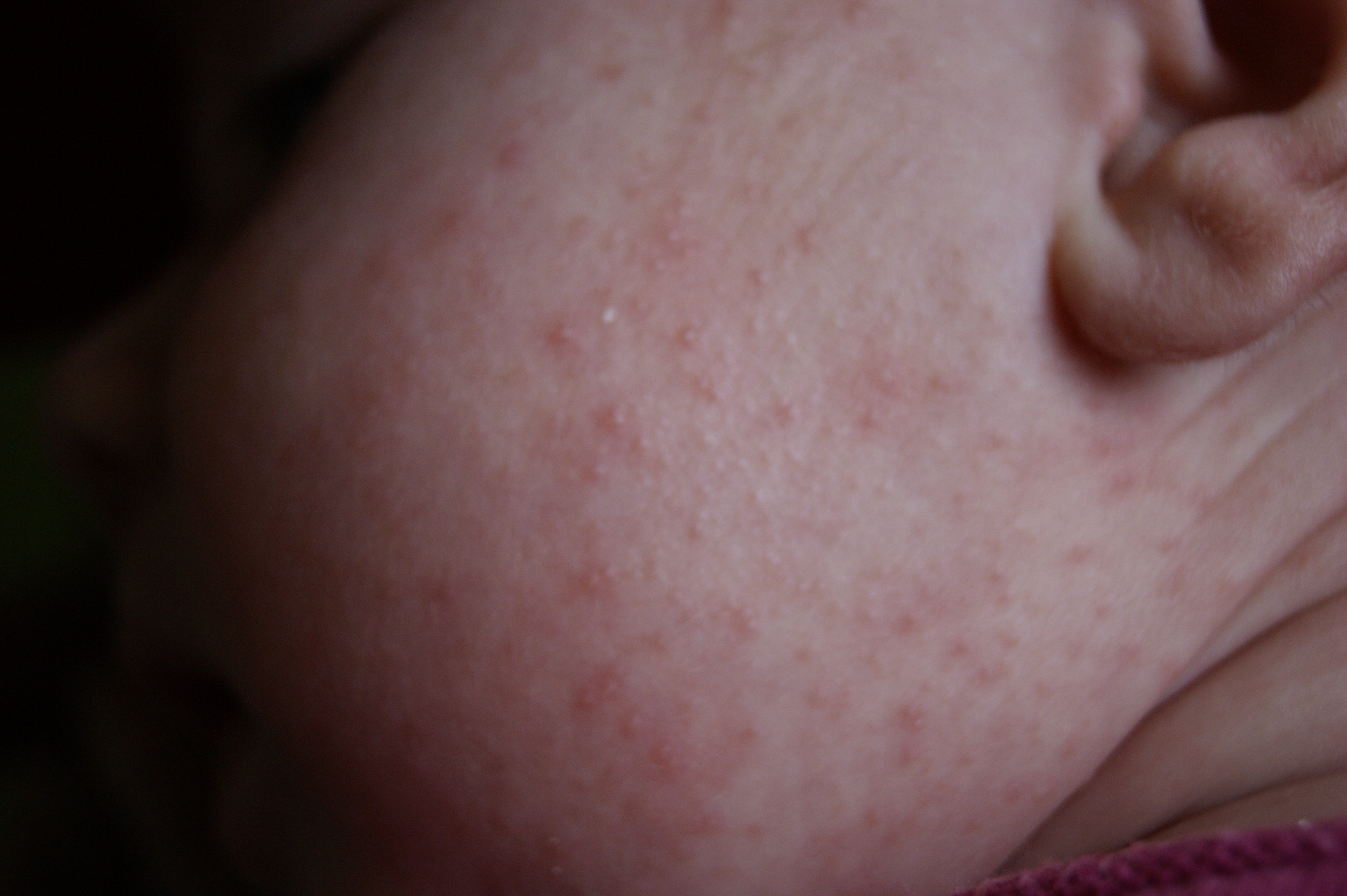 Plaques Rouges Sur Bebe Allergies Et Eczema Forum Sante Doctissimo Plaques Rouges Sur Bebe Allergies Et Eczema Forum Sante Doctissimo