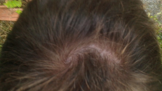 Début de calvitie du vertex