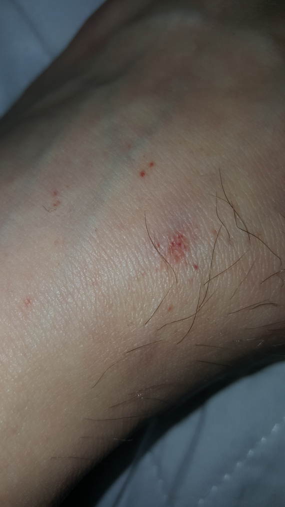 Taches violettes sur la cuisse