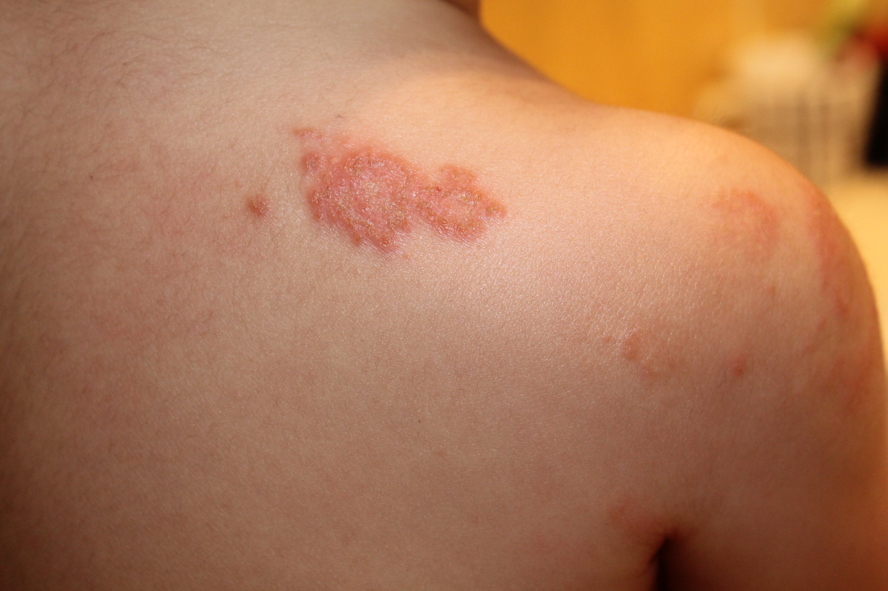 Staphylocoque Bebe Cure Thermale Conseils Forum Libre Sante Forum Sante Doctissimo Staphylocoque Bebe Cure Thermale Conseils Forum Libre Sante Forum Sante Doctissimo