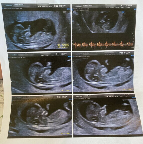 Pronostic Sexe Bebe 11sa 2