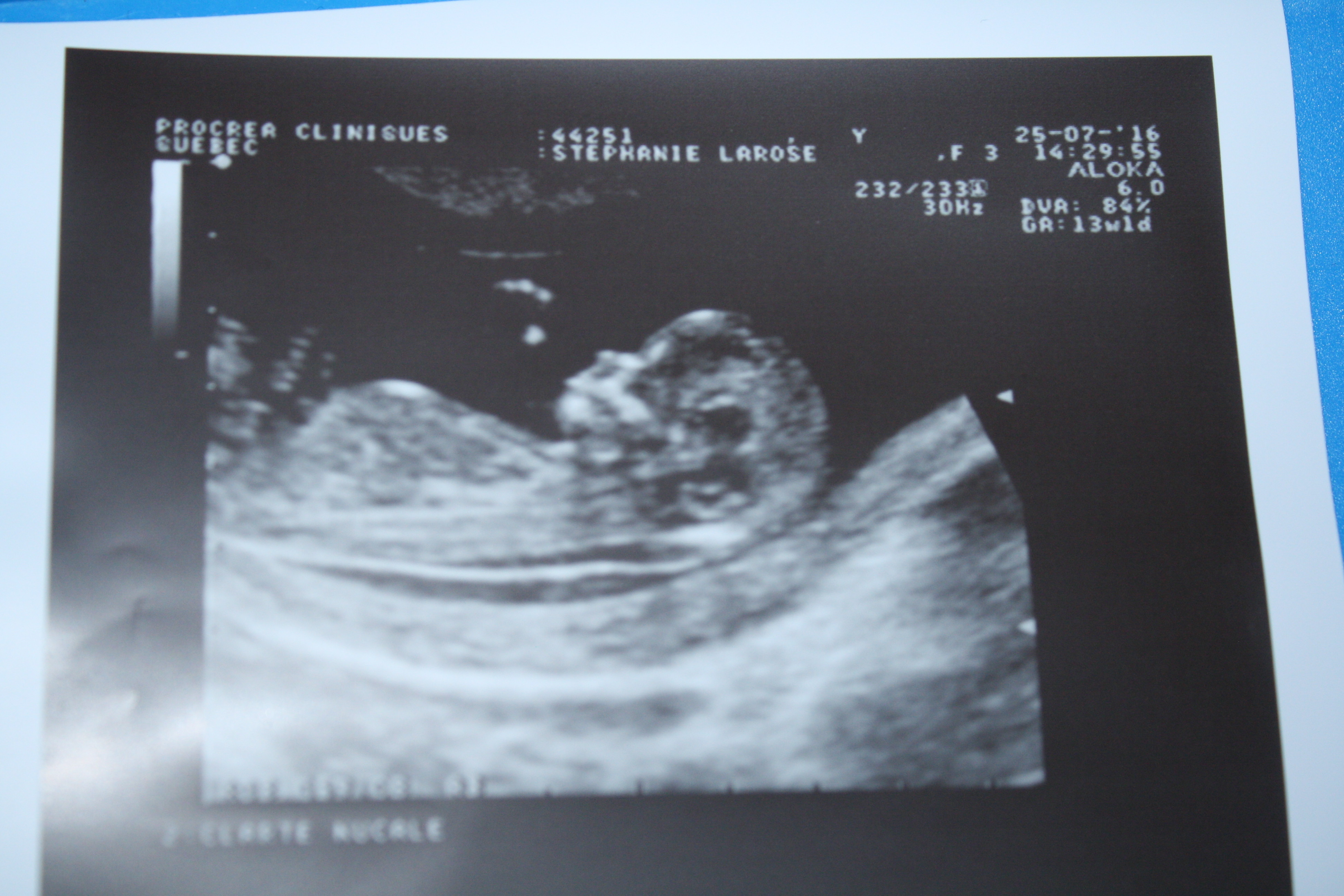 Clarte Nucale A 3 Mm Amniocentese Forum Grossesse Amp Bebe Doctissimo Clarte Nucale A 3 Mm Amniocentese Forum Grossesse Amp Bebe Doctissimo