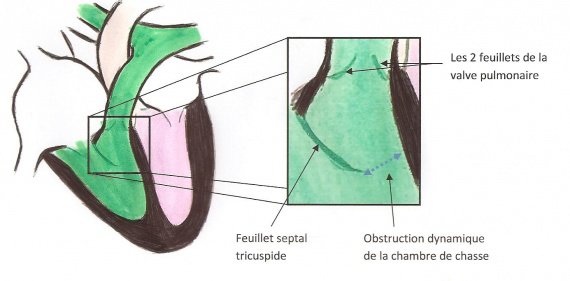 Obstruction dynamique de la CCVD (2)