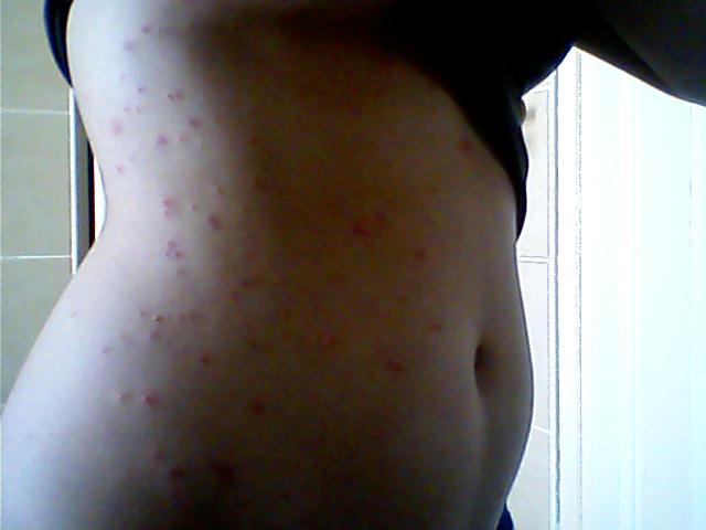 Boutons Rouges Sur Le Ventre Et Les Cuisses Help Acne Psoriasis Et Problemes De Peau Forum Sante Doctissimo Boutons Rouges Sur Le Ventre Et Les Cuisses Help Acne Psoriasis Et Problemes De Peau Forum Sante Doctissimo