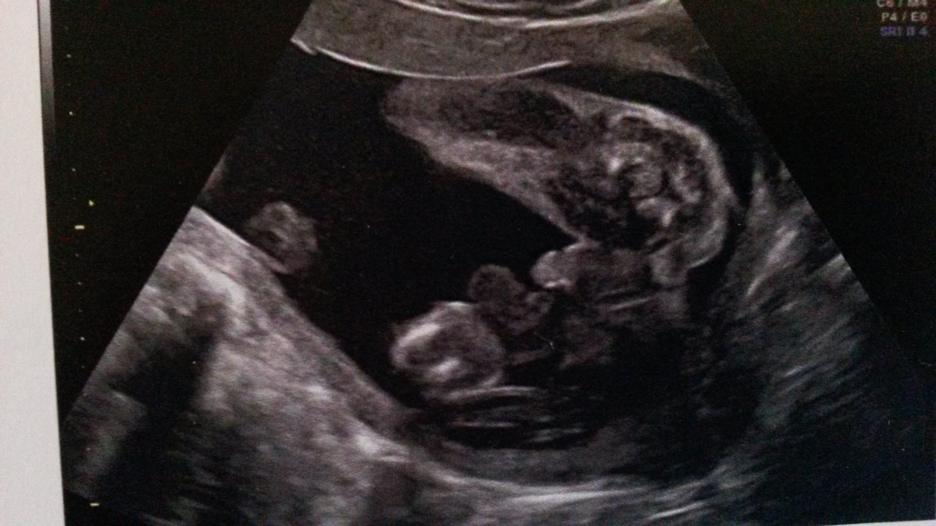 Echo Du 2eme Trimestre Echographie Connaitre Le Sexe De Votre Bebe Forum Grossesse Amp Bebe Doctissimo