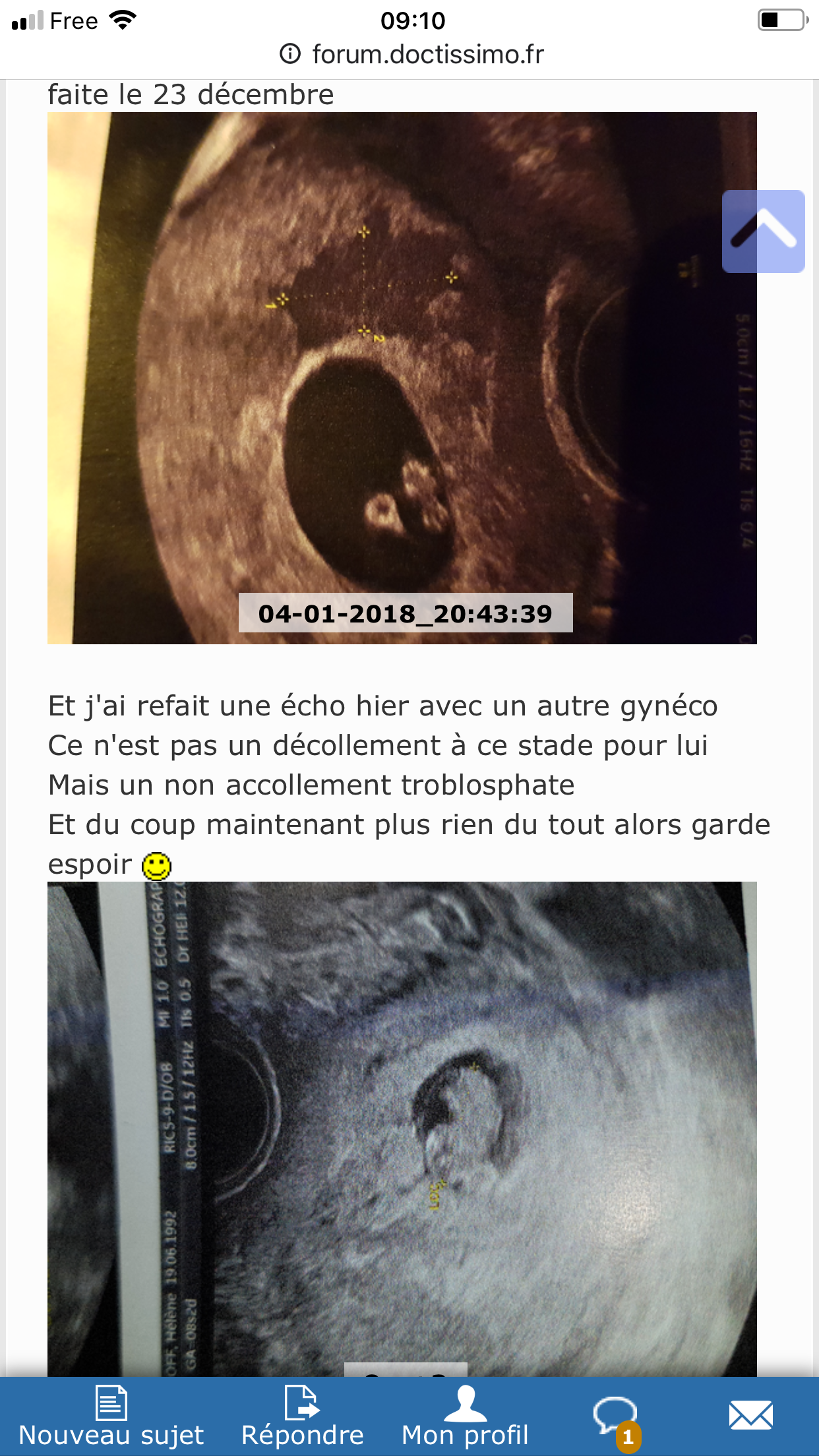 Leger Decollement 6 Sa Grossesse Forum Grossesse Amp Bebe Doctissimo Leger Decollement 6 Sa Grossesse Forum Grossesse Amp Bebe Doctissimo