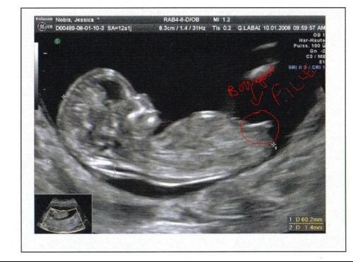 Sexe De Bebe Avec Les Echos Des 12 Semaines