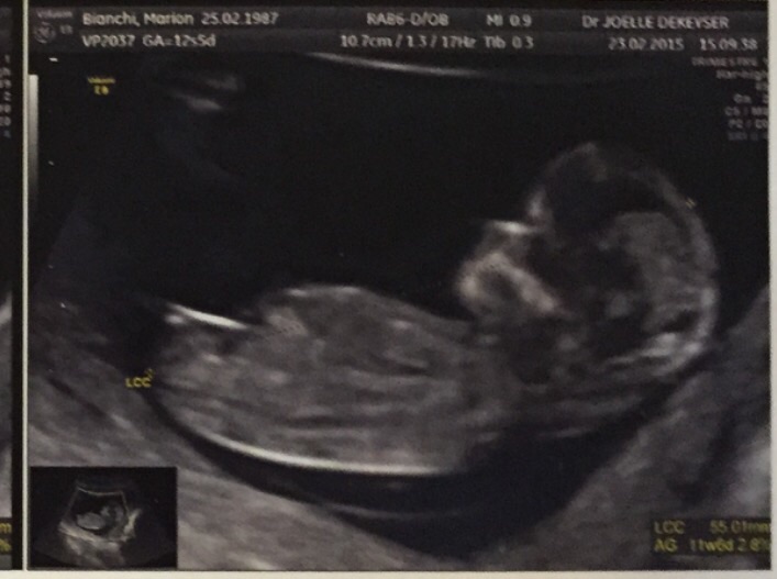 Tubercule Genital Fille Ou Garcon Echographie Connaitre Le Sexe De Votre Bebe Forum Grossesse Amp Bebe Doctissimo Tubercule Genital Fille Ou Garcon Echographie Connaitre Le Sexe De Votre Bebe Forum Grossesse Amp Bebe Doctissimo