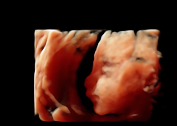 Echo 22sa 3d Futur Bebe 3 Es T Elle Photos Club Doctissimo Echo 22sa 3d Futur Bebe 3 Es T Elle Photos Club Doctissimo
