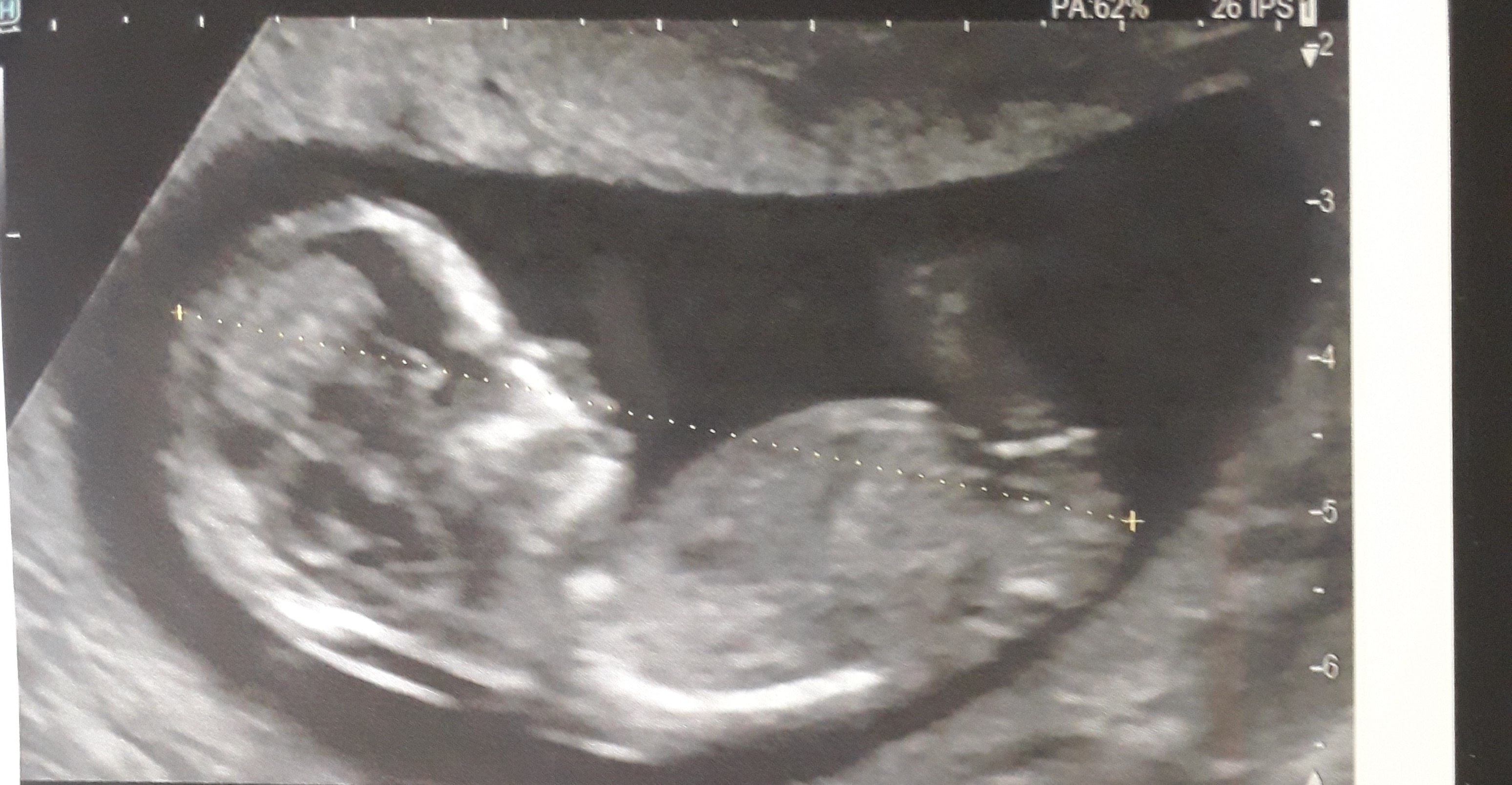 Echo 12 Sa 4 Echographie Connaitre Le Sexe De Votre Bebe Forum Grossesse Amp Bebe Doctissimo Echo 12 Sa 4 Echographie Connaitre Le Sexe De Votre Bebe Forum Grossesse Amp Bebe Doctissimo