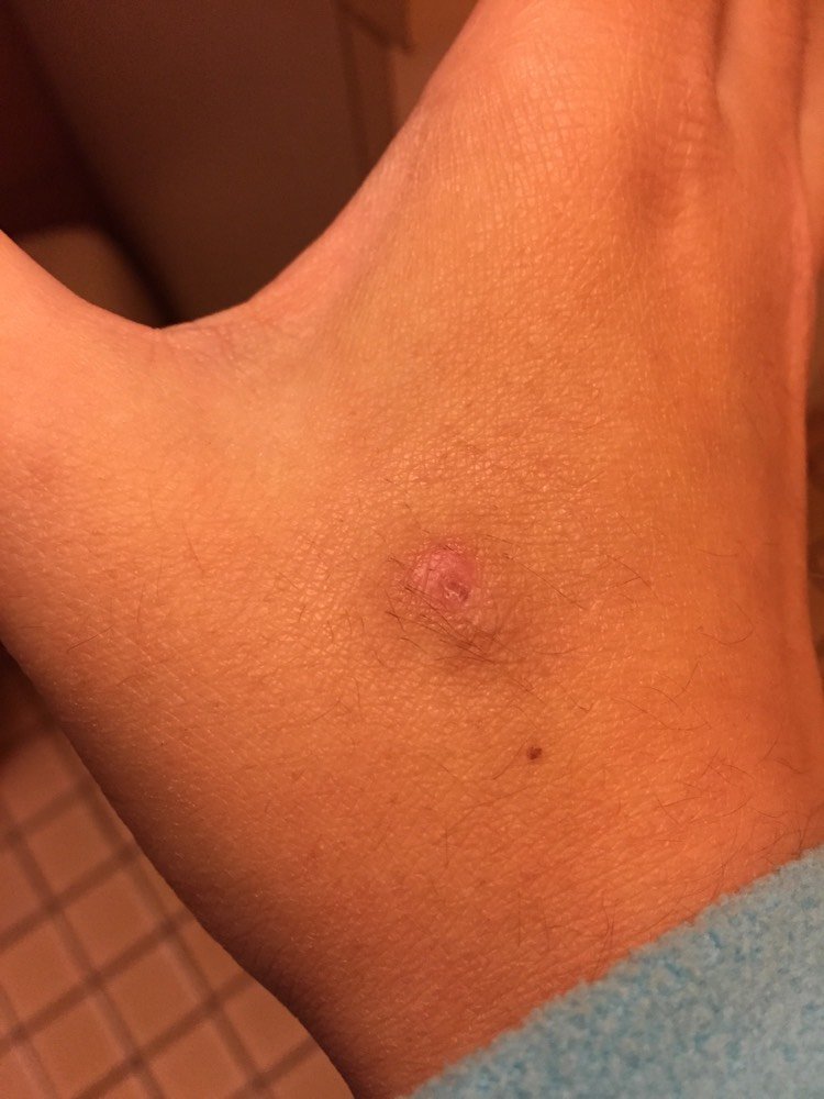 Rejet Microdermal Que Faire Tatouages Et Piercings Forum Beaute Doctissimo Rejet Microdermal Que Faire Tatouages Et Piercings Forum Beaute Doctissimo